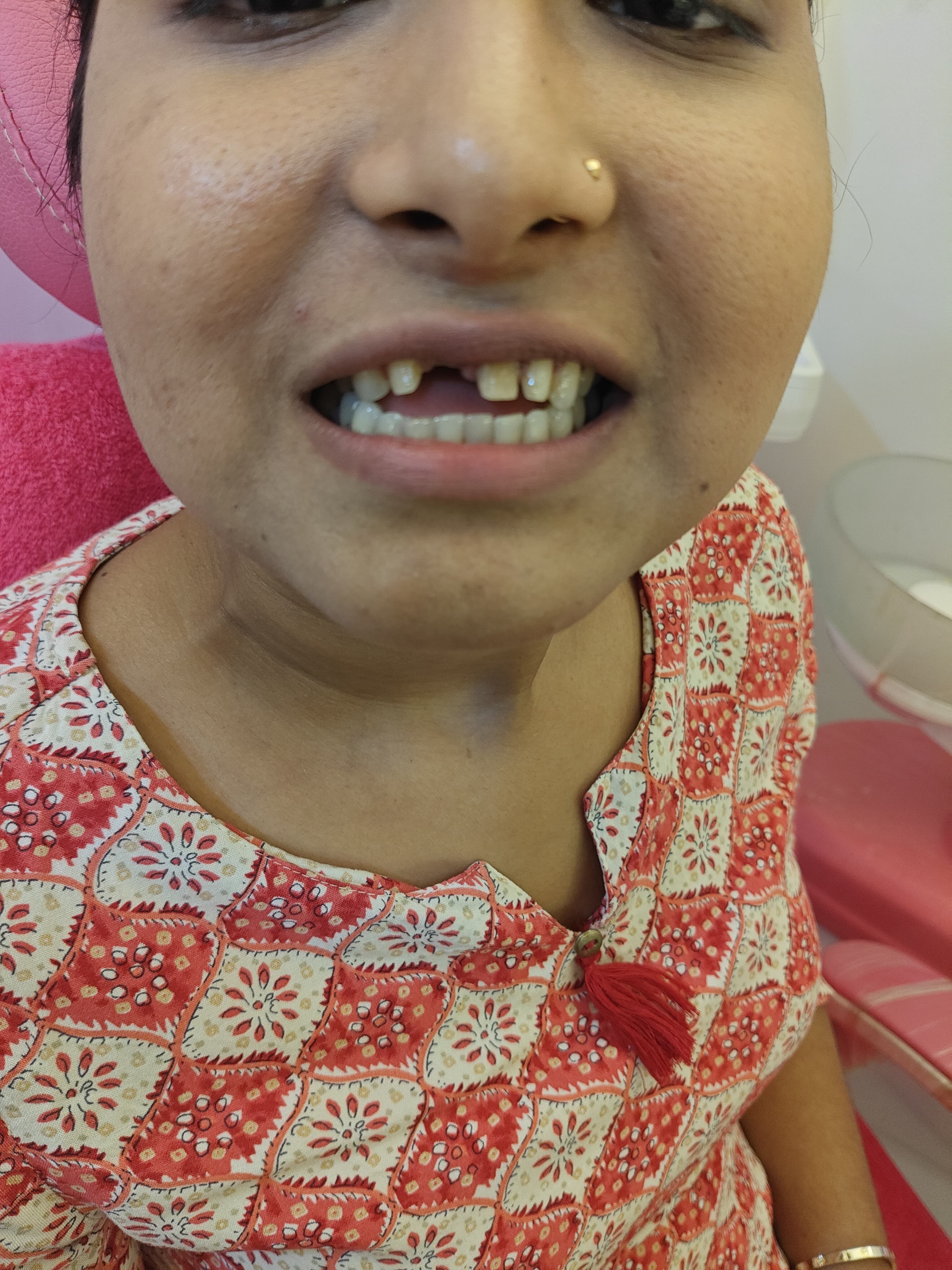 Smile Transformation Case 1